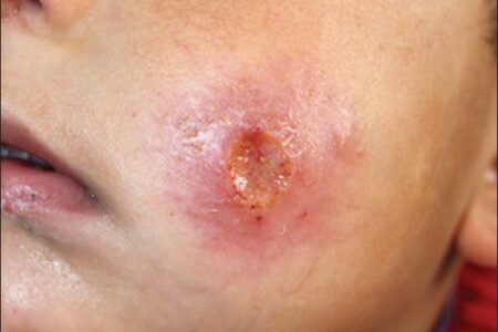 إقليم تازة..جهود مكثفة للصحة لمكافحة اللشمانيا والحالات المصابة عادية لا تدعو للقلق